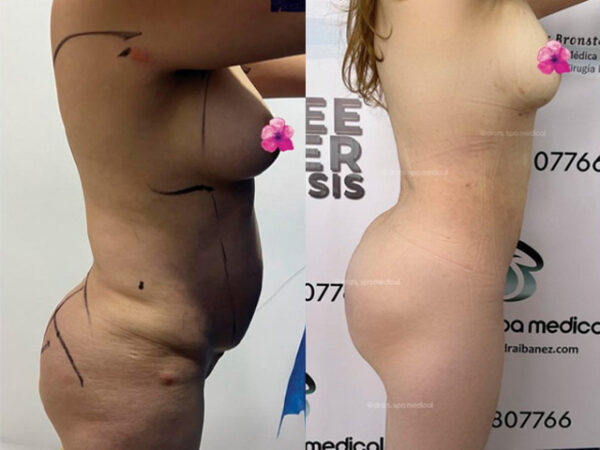 Lipoescultura Three Láser